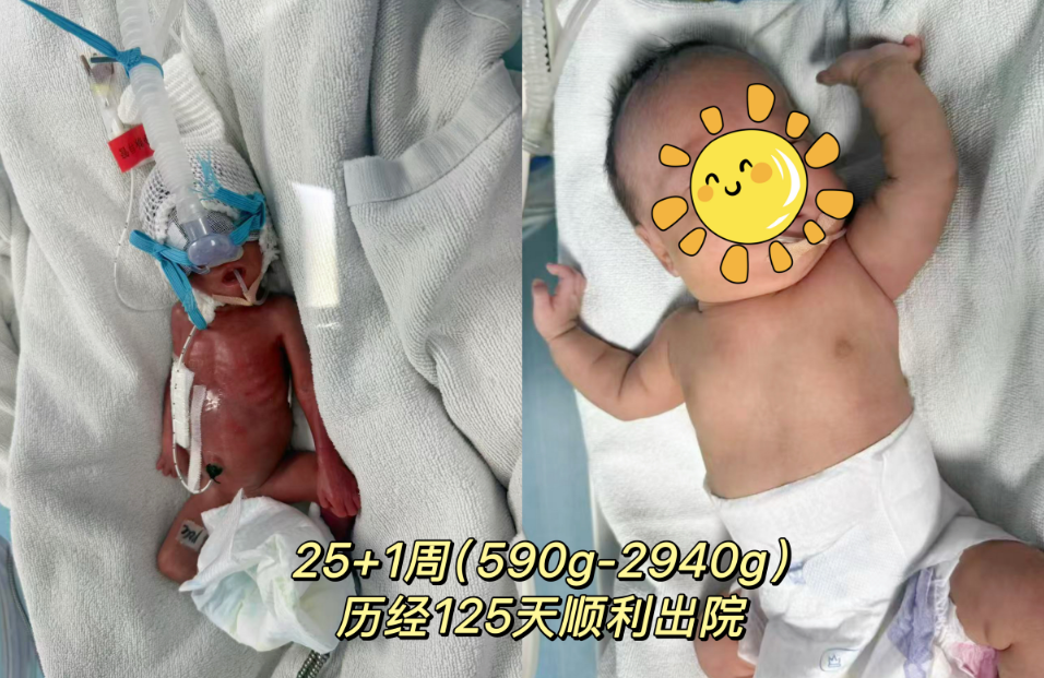 生命奇跡再刷新！懷化市婦幼保健院成功救治 25 周 出生體重僅590g的“掌心寶寶”